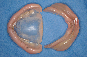 米子市新開・けやき歯科・痛んでいる歯ぐきを治療・強化する治療用義歯