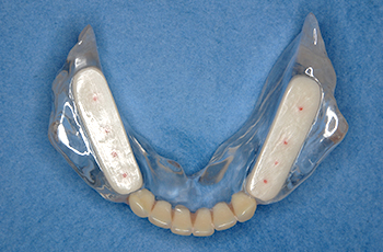 米子市新開・けやき歯科・かみ合わせを正常に戻す治療用義歯