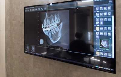 米子市新開・けやき歯科・検査結果のご説明・治療計画のご提案