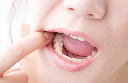 米子市新開・けやき歯科・むし歯