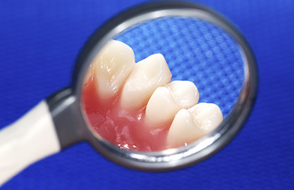 米子市新開・けやき歯科・歯周病